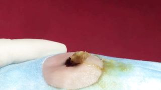 BEST Pimple Popping Big Cystic Acne Blackheads Whiteheads Removal Squeezing Pimples H052_720p - 011