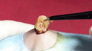 BEST Pimple Popping Big Cystic Acne Blackheads Whiteheads Removal Squeezing Pimples H052_720p - 012