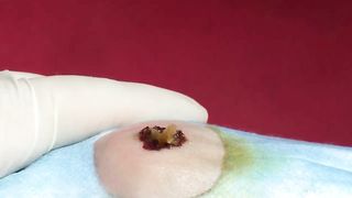 BEST Pimple Popping Big Cystic Acne Blackheads Whiteheads Removal Squeezing Pimples H052_720p - 013