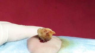 BEST Pimple Popping Big Cystic Acne Blackheads Whiteheads Removal Squeezing Pimples H052_720p - 014