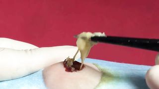 BEST Pimple Popping Big Cystic Acne Blackheads Whiteheads Removal Squeezing Pimples H052_720p - 015
