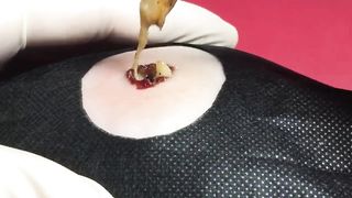 BEST Pimple Popping Big Cystic Acne Blackheads Whiteheads Removal Squeezing Pimples H053_720p - 001