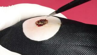 BEST Pimple Popping Big Cystic Acne Blackheads Whiteheads Removal Squeezing Pimples H053_720p - 002