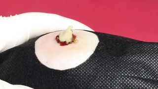 BEST Pimple Popping Big Cystic Acne Blackheads Whiteheads Removal Squeezing Pimples H053_720p - 003