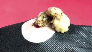 BEST Pimple Popping Big Cystic Acne Blackheads Whiteheads Removal Squeezing Pimples H053_720p - 004