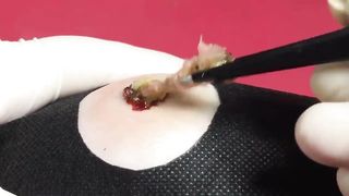 BEST Pimple Popping Big Cystic Acne Blackheads Whiteheads Removal Squeezing Pimples H053_720p - 005