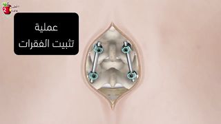 د فارس عرب  يشرح أسباب فشل جراحة الفقرات والألم المستمر