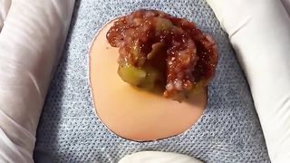 BEST Pimple Popping Big Cystic Acne Blackheads Whiteheads Removal Squeezing Pimples H054_720p - 001
