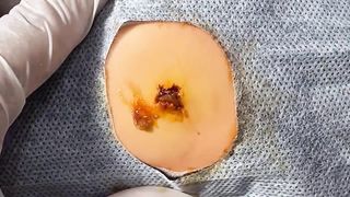 BEST Pimple Popping Big Cystic Acne Blackheads Whiteheads Removal Squeezing Pimples H054_720p - 003