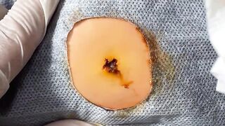 BEST Pimple Popping Big Cystic Acne Blackheads Whiteheads Removal Squeezing Pimples H054_720p - 005