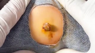 BEST Pimple Popping Big Cystic Acne Blackheads Whiteheads Removal Squeezing Pimples H054_720p - 006