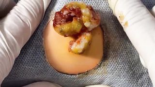 BEST Pimple Popping Big Cystic Acne Blackheads Whiteheads Removal Squeezing Pimples H054_720p - 007