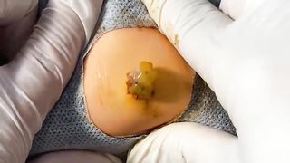BEST Pimple Popping Big Cystic Acne Blackheads Whiteheads Removal Squeezing Pimples H054_720p - 008