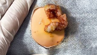 BEST Pimple Popping Big Cystic Acne Blackheads Whiteheads Removal Squeezing Pimples H054_720p - 009
