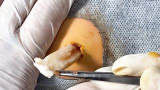BEST Pimple Popping Big Cystic Acne Blackheads Whiteheads Removal Squeezing Pimples H054_720p - 010