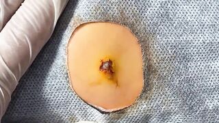 BEST Pimple Popping Big Cystic Acne Blackheads Whiteheads Removal Squeezing Pimples H054_720p - 011