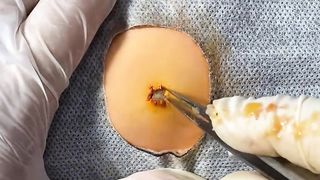 BEST Pimple Popping Big Cystic Acne Blackheads Whiteheads Removal Squeezing Pimples H054_720p - 013