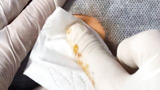 BEST Pimple Popping Big Cystic Acne Blackheads Whiteheads Removal Squeezing Pimples H054_720p - 014