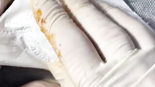 BEST Pimple Popping Big Cystic Acne Blackheads Whiteheads Removal Squeezing Pimples H054_720p - 015