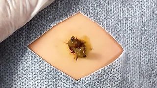 BEST Pimple Popping Big Cystic Acne Blackheads Whiteheads Removal Squeezing Pimples H055_720p - 001