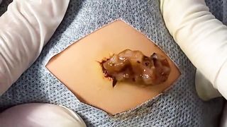 BEST Pimple Popping Big Cystic Acne Blackheads Whiteheads Removal Squeezing Pimples H055_720p - 002
