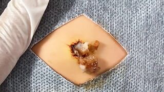 BEST Pimple Popping Big Cystic Acne Blackheads Whiteheads Removal Squeezing Pimples H055_720p - 003