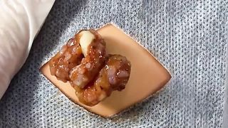 BEST Pimple Popping Big Cystic Acne Blackheads Whiteheads Removal Squeezing Pimples H055_720p - 004