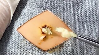 BEST Pimple Popping Big Cystic Acne Blackheads Whiteheads Removal Squeezing Pimples H055_720p - 005