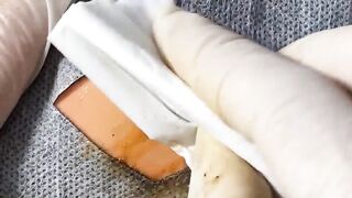 BEST Pimple Popping Big Cystic Acne Blackheads Whiteheads Removal Squeezing Pimples H055_720p - 006