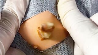 BEST Pimple Popping Big Cystic Acne Blackheads Whiteheads Removal Squeezing Pimples H055_720p - 007