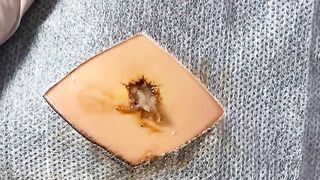 BEST Pimple Popping Big Cystic Acne Blackheads Whiteheads Removal Squeezing Pimples H055_720p - 008