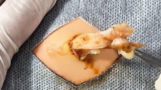 BEST Pimple Popping Big Cystic Acne Blackheads Whiteheads Removal Squeezing Pimples H055_720p - 009