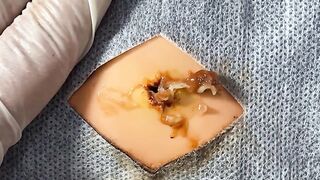 BEST Pimple Popping Big Cystic Acne Blackheads Whiteheads Removal Squeezing Pimples H055_720p - 010