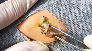 BEST Pimple Popping Big Cystic Acne Blackheads Whiteheads Removal Squeezing Pimples H055_720p - 011