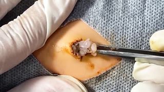 BEST Pimple Popping Big Cystic Acne Blackheads Whiteheads Removal Squeezing Pimples H055_720p - 012