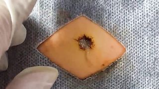 BEST Pimple Popping Big Cystic Acne Blackheads Whiteheads Removal Squeezing Pimples H055_720p - 013