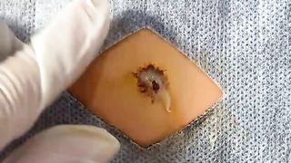 BEST Pimple Popping Big Cystic Acne Blackheads Whiteheads Removal Squeezing Pimples H055_720p - 014