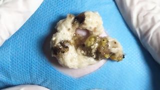 BEST Pimple Popping Big Cystic Acne Blackheads Whiteheads Removal Squeezing Pimples H060_720p - 001