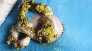 BEST Pimple Popping Big Cystic Acne Blackheads Whiteheads Removal Squeezing Pimples H060_720p - 005