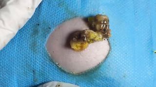 BEST Pimple Popping Big Cystic Acne Blackheads Whiteheads Removal Squeezing Pimples H060_720p - 006