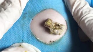 BEST Pimple Popping Big Cystic Acne Blackheads Whiteheads Removal Squeezing Pimples H060_720p - 007