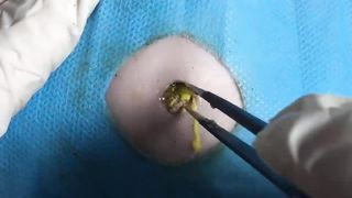BEST Pimple Popping Big Cystic Acne Blackheads Whiteheads Removal Squeezing Pimples H060_720p - 008