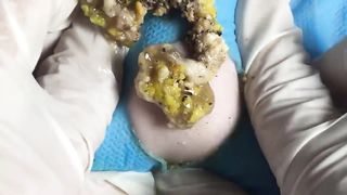 BEST Pimple Popping Big Cystic Acne Blackheads Whiteheads Removal Squeezing Pimples H060_720p - 009