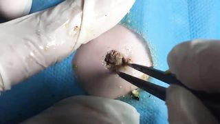 BEST Pimple Popping Big Cystic Acne Blackheads Whiteheads Removal Squeezing Pimples H060_720p - 010