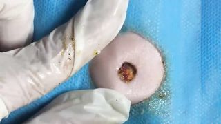 BEST Pimple Popping Big Cystic Acne Blackheads Whiteheads Removal Squeezing Pimples H060_720p - 015