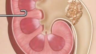 Kidney Stone Procedure - PreOp® Patient Education #preop #patienteducation #medical #shorts.