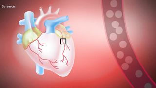 Coronary Artery Disease (CAD) _ Causes, Symptoms And Preventions (3D Animation)