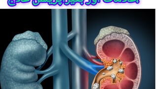 گردے کی پتھری کی وجوہات اقسام اور بغیر آپریشن علاج