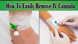 How To Remove IV Cannula