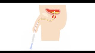 Foley catheter, its insertion and Function